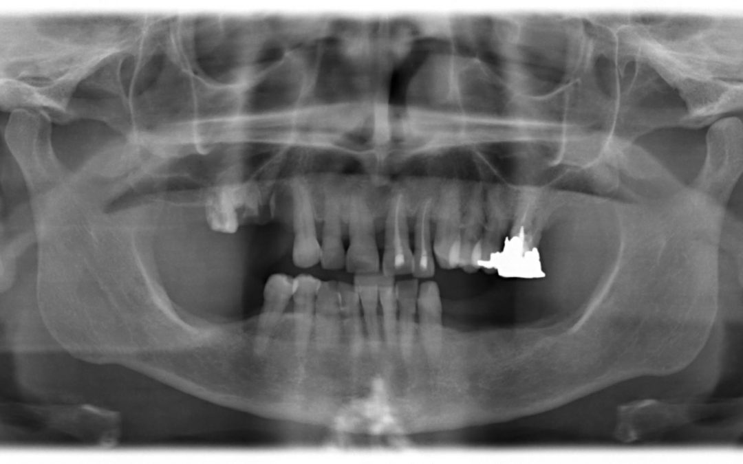 Maxilla Fixed Option