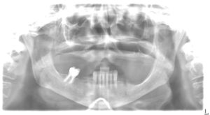 Tretament option in the maxilla