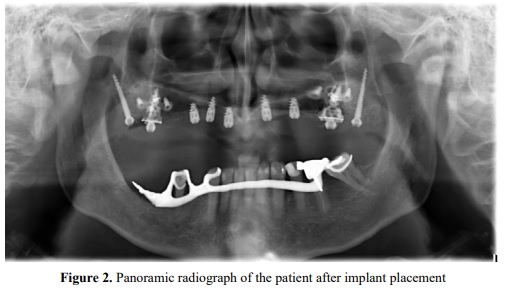 No bone graft