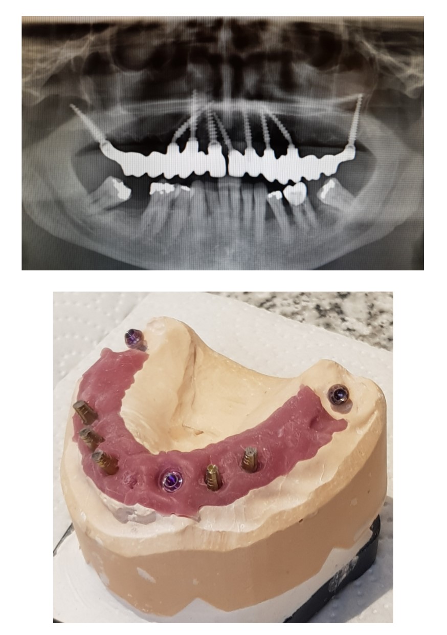 No bone graft