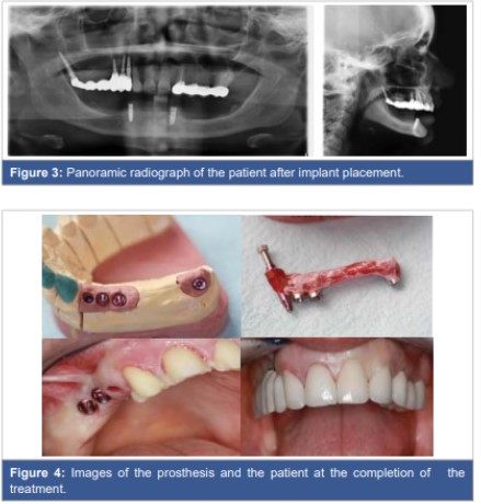 No bone graft