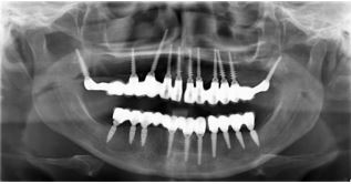 Minimal Invasive Implant Dentistry