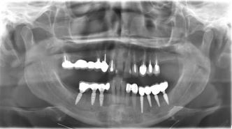 Pterygoid Implants