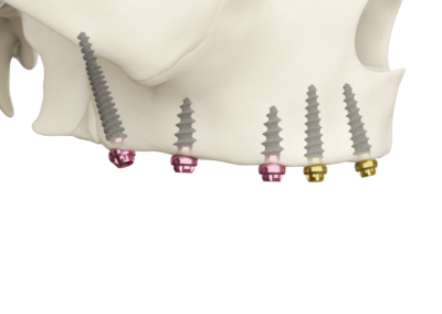 Minimal Invasive Implant Dentistry