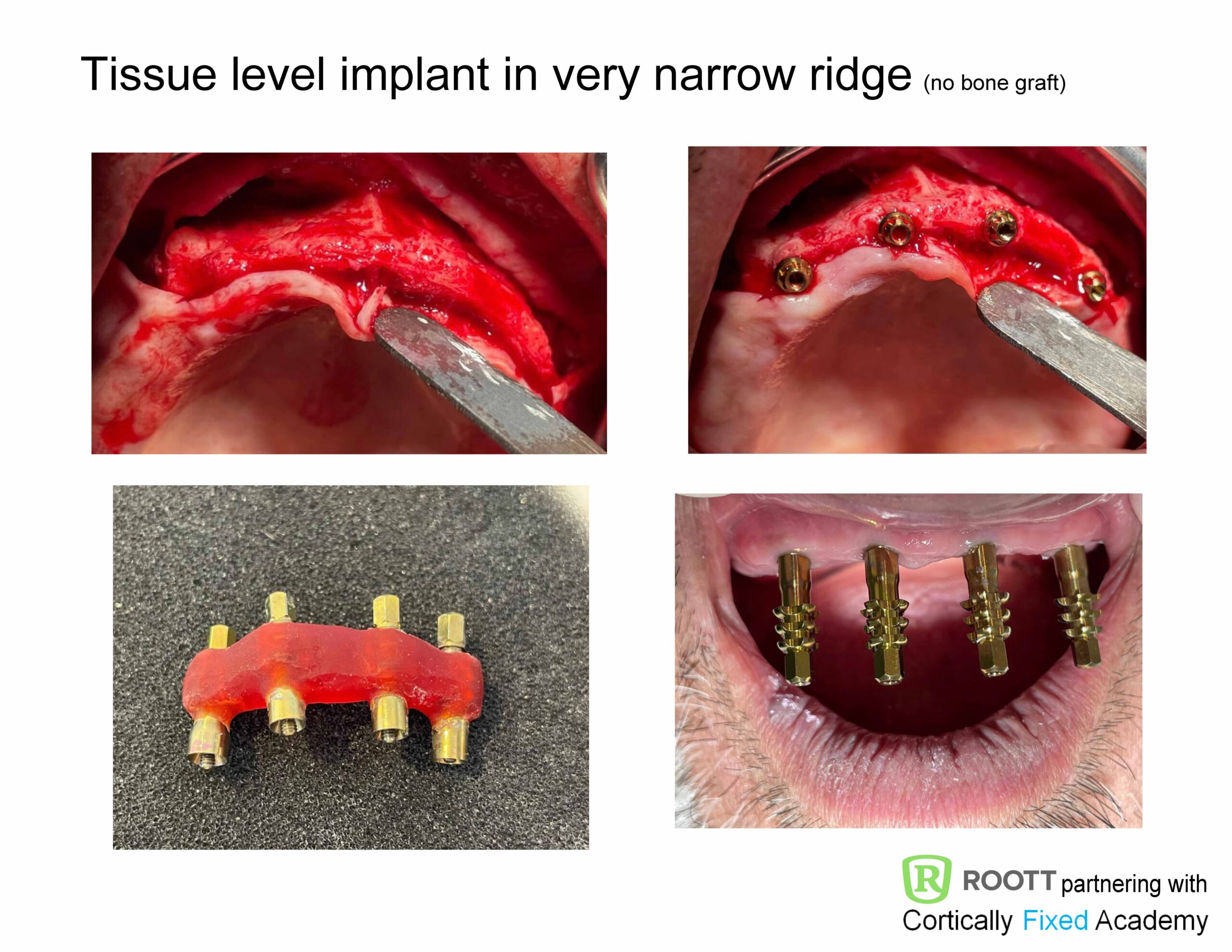 Pterygoid Implants